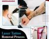Tattoo Removal Process - MEDermis Laser Clinic
