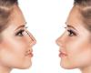 Enhance Your Beauty with Nasal Correction and Rhinoplasty in Vienna | Dr. Najib Chichakli