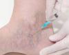Sclerotherapy Treatment For Varicose And Spider veins In New Jersey | Advanced Medical Group